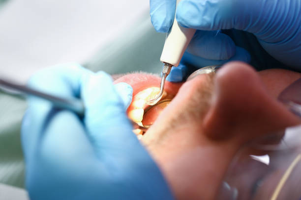 Best Emergency Treatment for Dental Infections or Abscesses in Gordonsville, VA