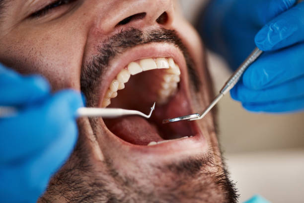 Best Emergency Dental Care for Broken or Chipped Teeth in Gordonsville, VA